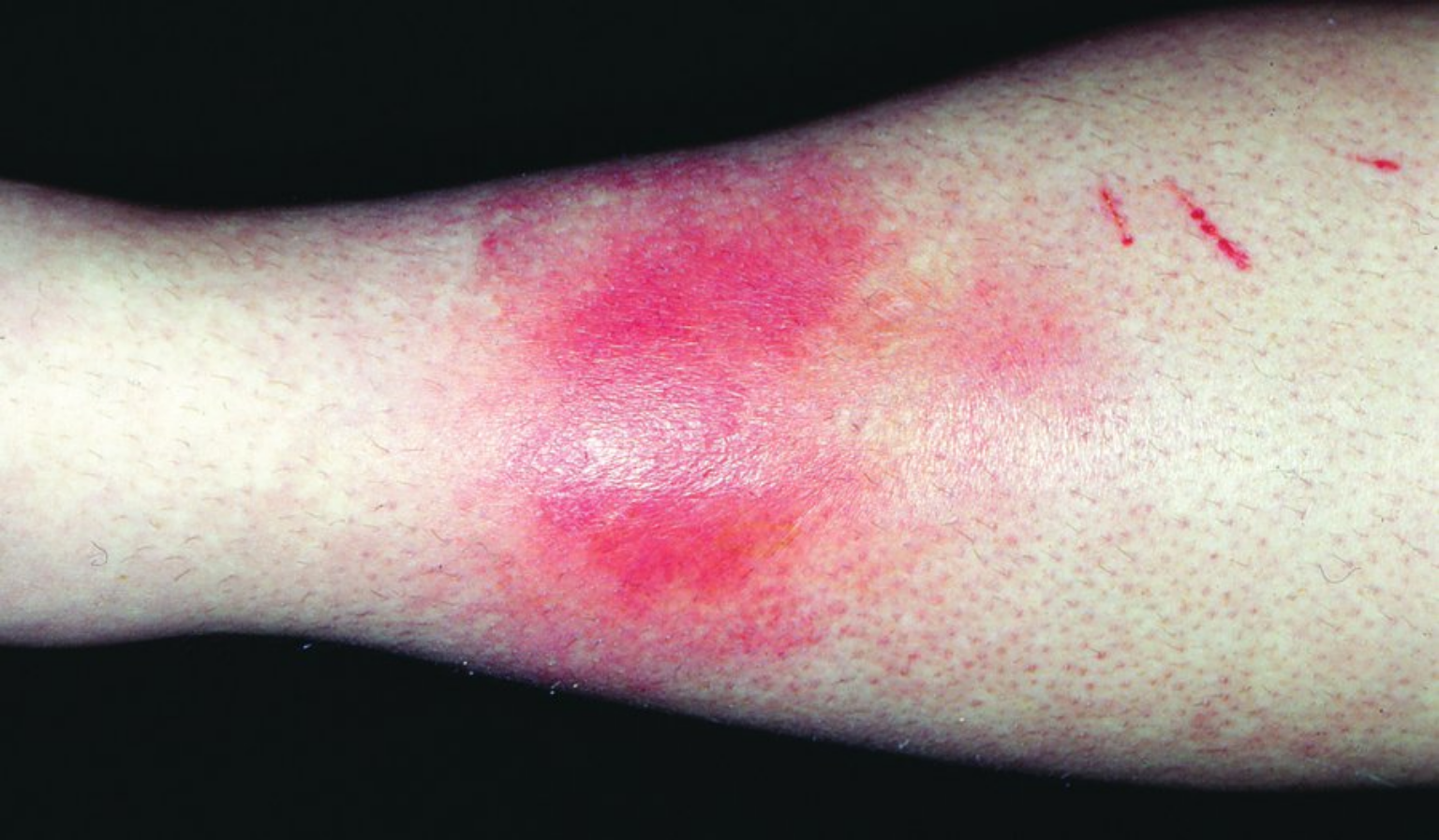 Erythema Nodosum Manifests As Painful Red brown Nodules On The Erythema Nodosum Manifests As Painful Red brown Nodules On The